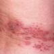 Illustration for article titled Obat Penyakit Herpes Sembuh Tuntasem/em